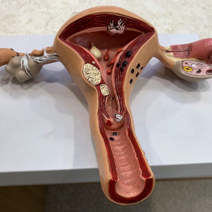 대전 다낭성난소증후군 – 자궁과 양쪽 난소 해부 모형