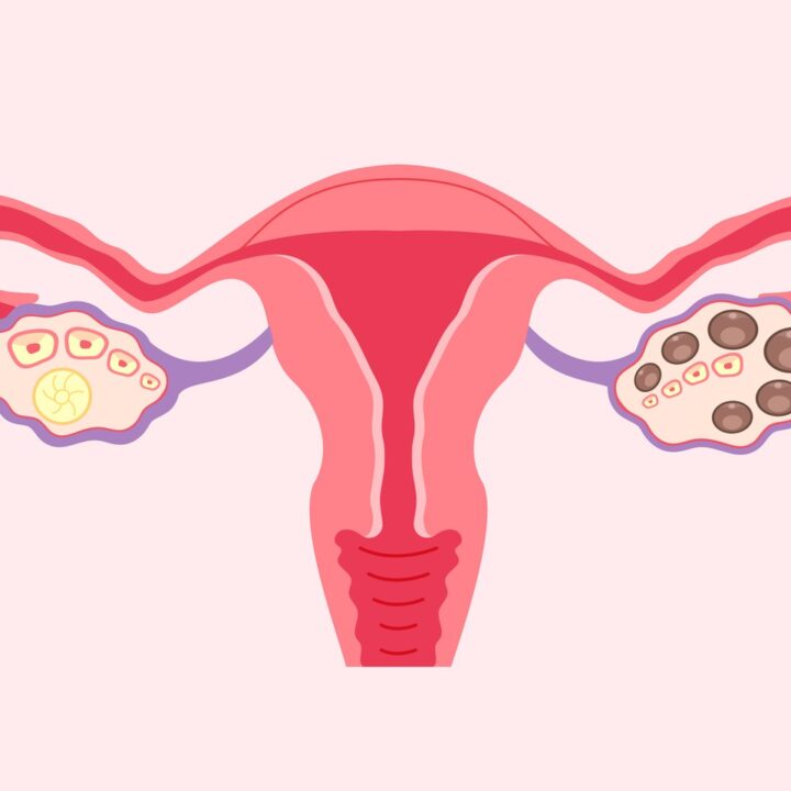 잠실 다낭성난소증후군 – 정상 난소와 다낭성 난소 도식