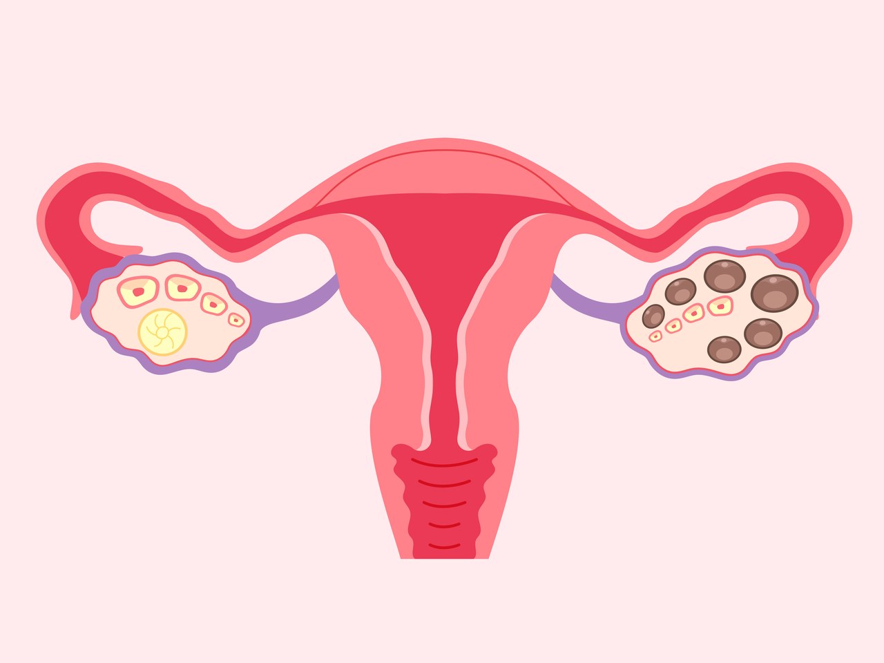 잠실 다낭성난소증후군 – 정상 난소와 다낭성 난소 도식