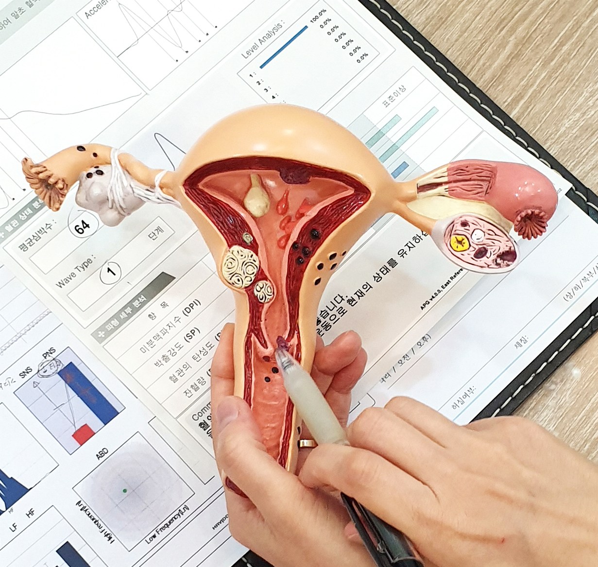 잠실 부정출혈 – 진료실에서 자궁 모형을 들고 출혈이 비치는 자리를 설명하는 한의사