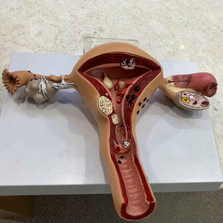 용산 자궁선근증 – 자궁 근육층과 난소 해부 모형